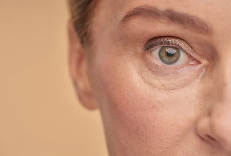 rellenar ojeras con ácido hialurónico