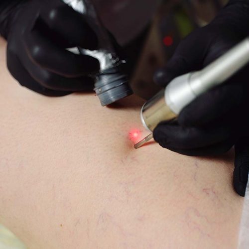 removal of rosacea or vascular mesh on the patient’s legs with a neodymium laser. removal of rosacea or vascular mesh on the patient's legs with a neodymium laser. Laser cosmetology